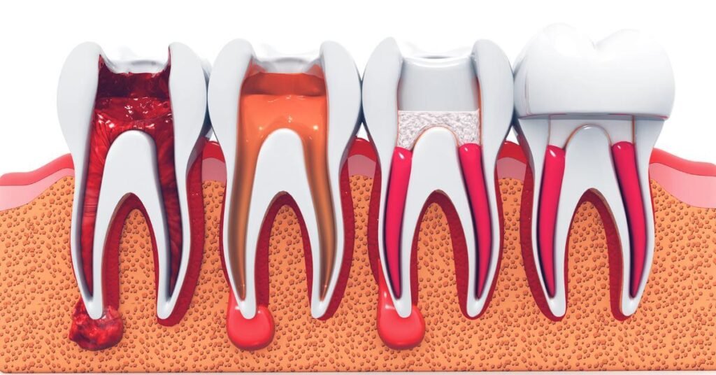 cracked tooth root canal