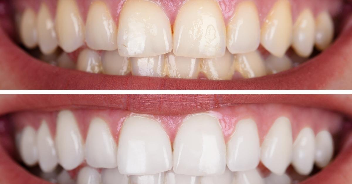 cosmetic teeth whitening