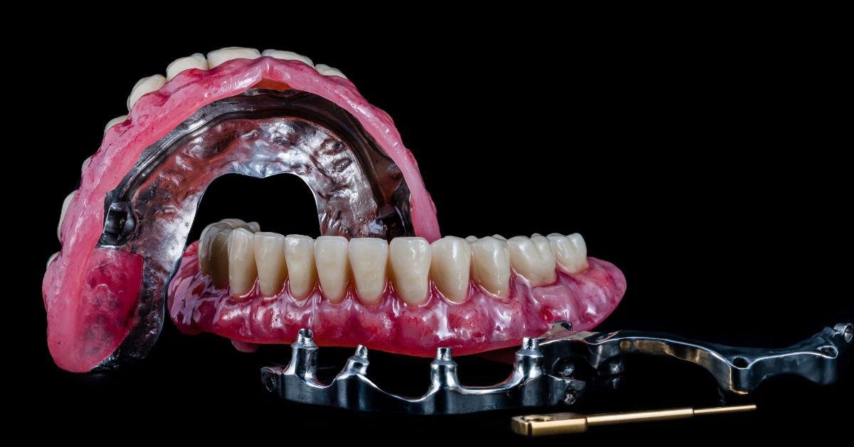 All-on-Four Dental Implants