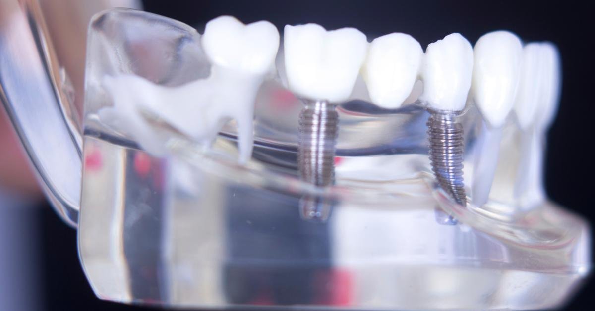 All-on-Four Dental Implants