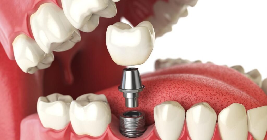 Dental implants dentures