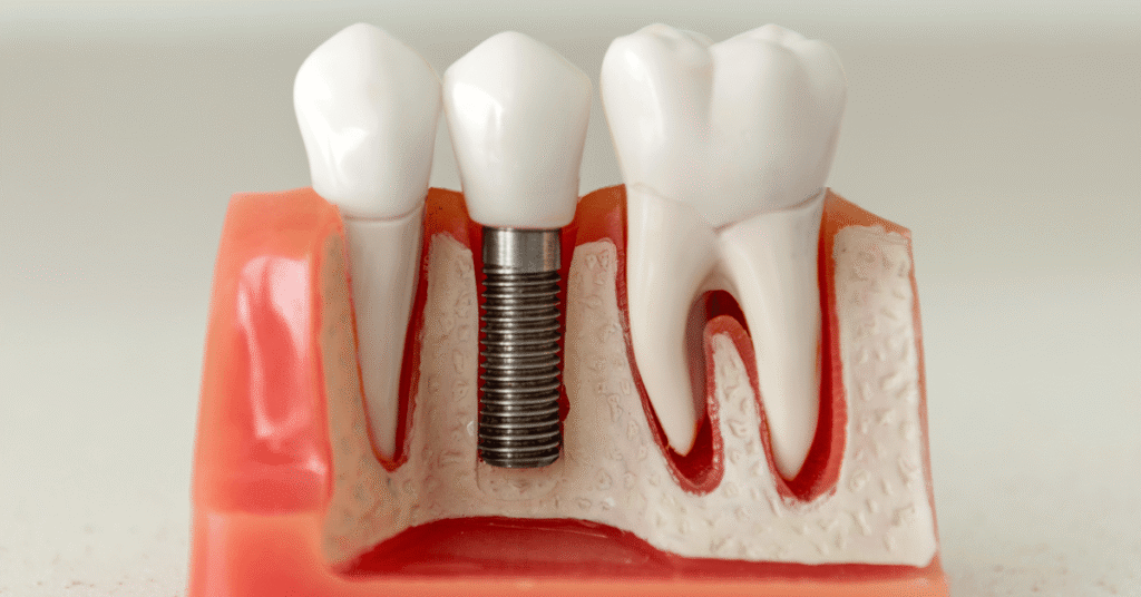 dental implants