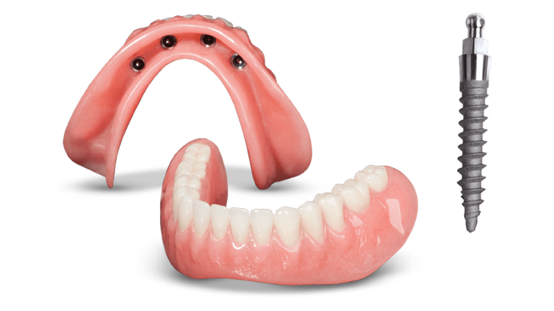 Mini Implant Dentures  