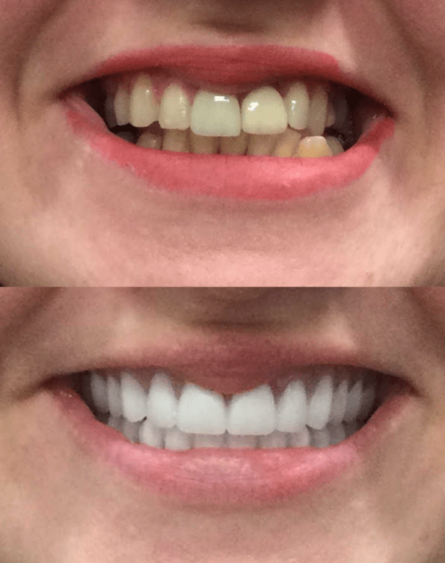 before and after dentures