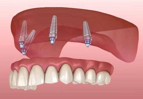 All on 4 Dentures