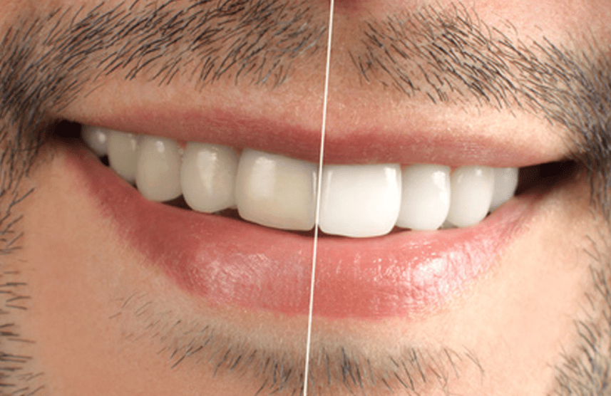 Teeth Whitening Edmonton