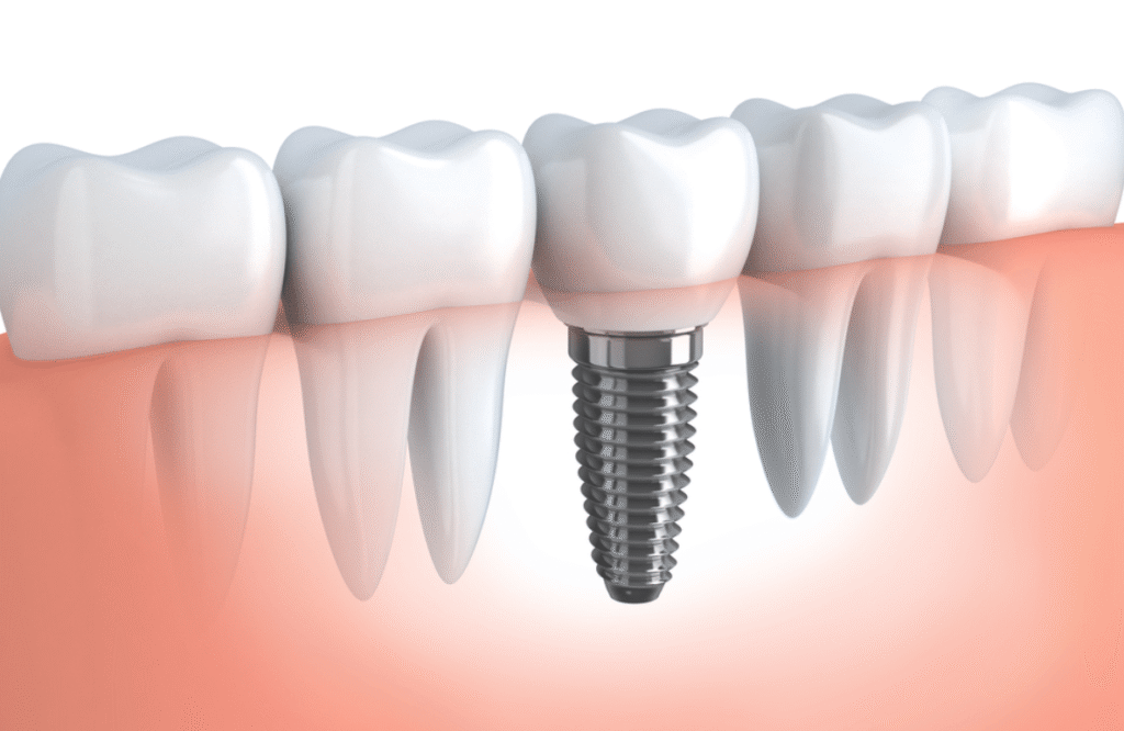 Why No Dairy After Dental Implant
