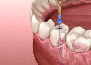 How much do dental fillings cost?