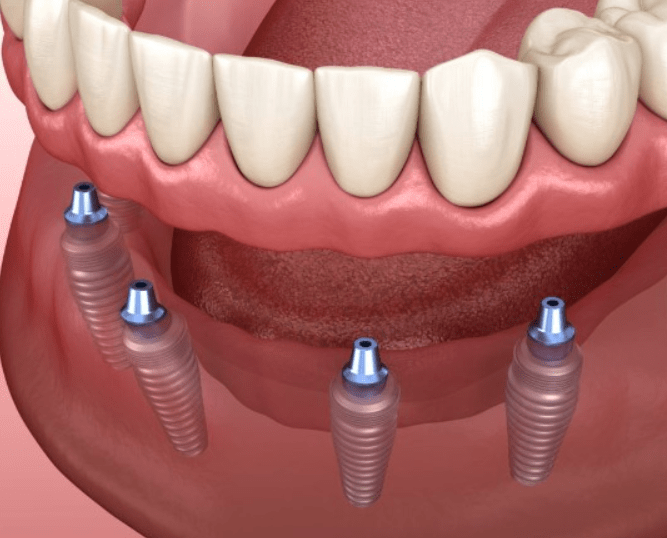 Lower Denture Problems And Solutions