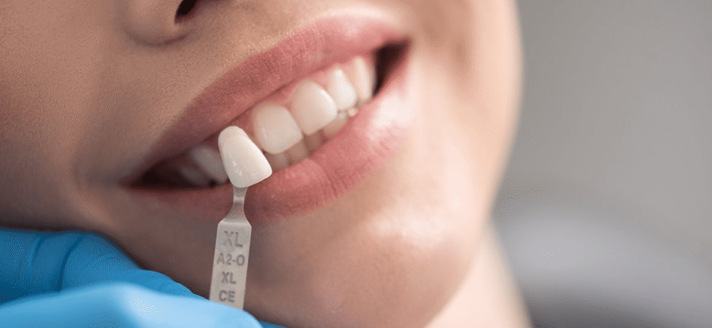 How Much Is A Tooth Filling Without Insurance