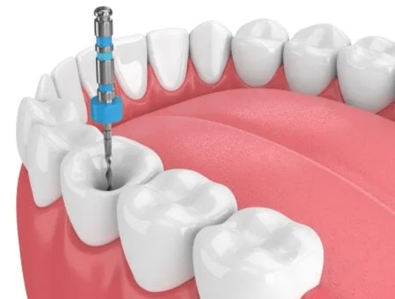 How long does it take to do a root canal?