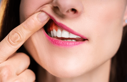 Pictures Of Denture Sores