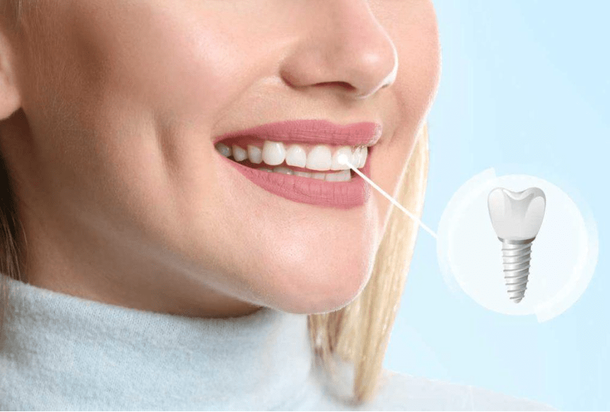 Mini dental implants