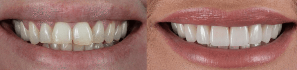 Pictures of bad dentures