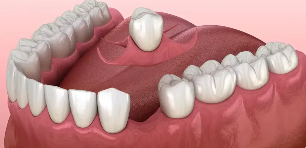 1 tooth partial denture