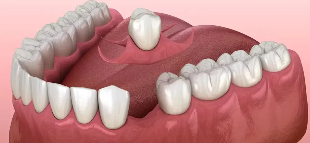 How does a single tooth denture stay in?