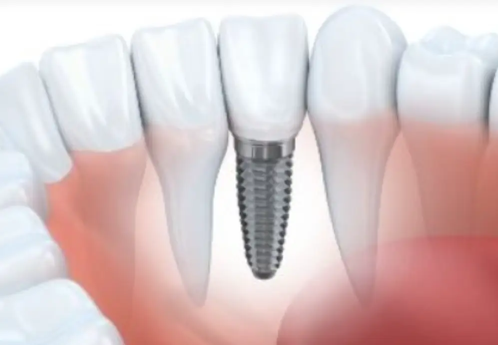 Lower partial dentures bottom front teeth