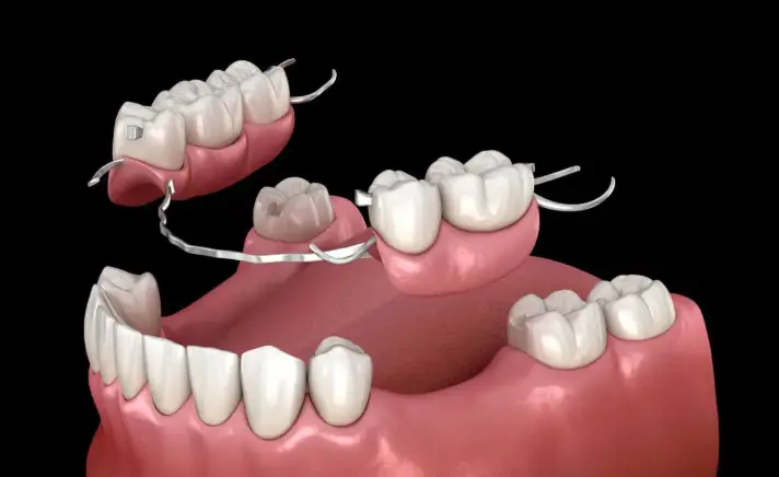 How long do dentures last?