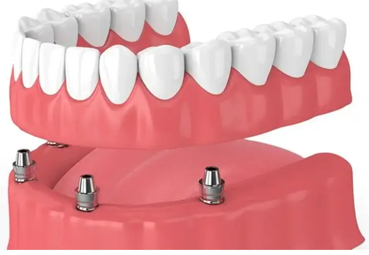 All on four dental implants