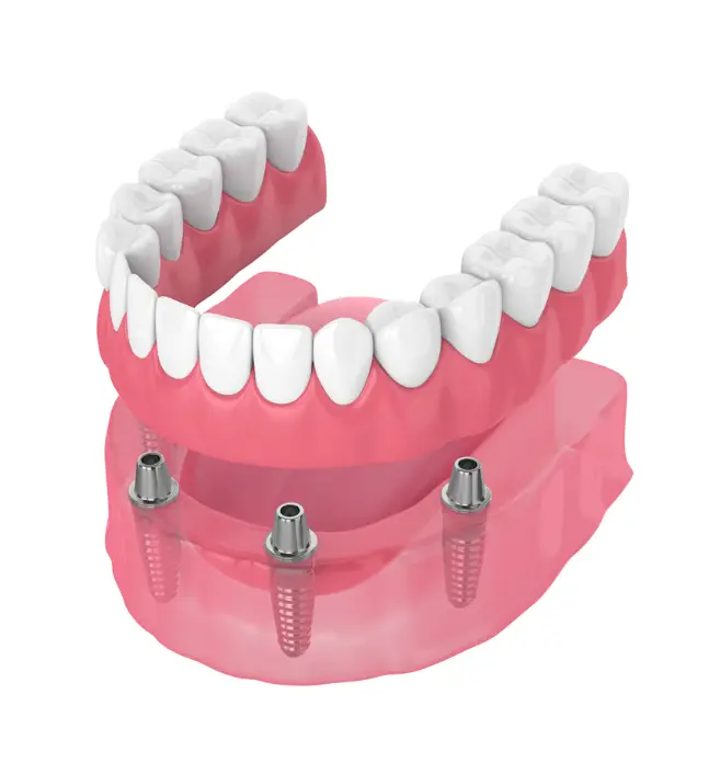 Implant retained dentures