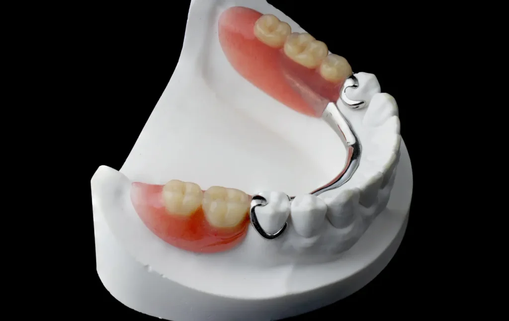 Metal partial denture
