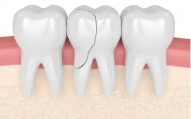 Cracked tooth root canal
