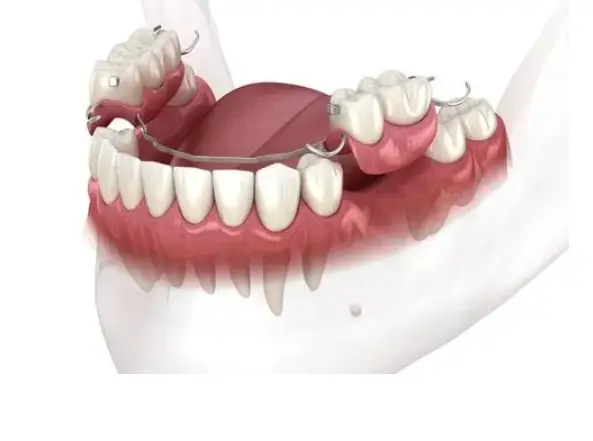 What do partial dentures look like?